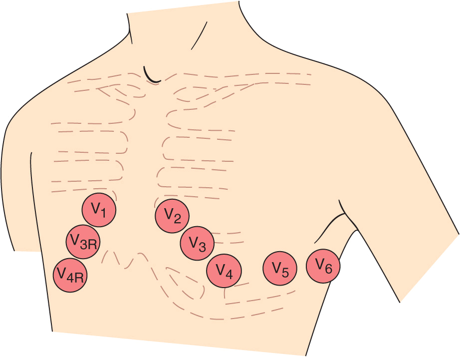 Electrocardiography | Thoracic Key