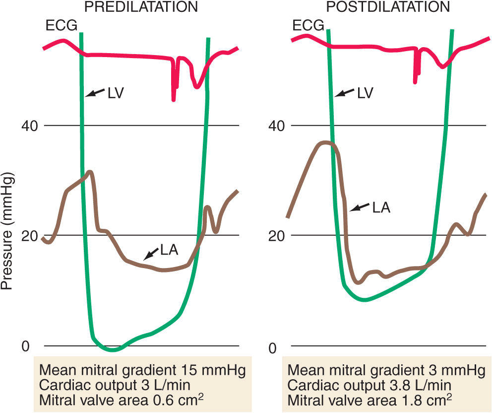 Valvular Heart Disease Thoracic Key