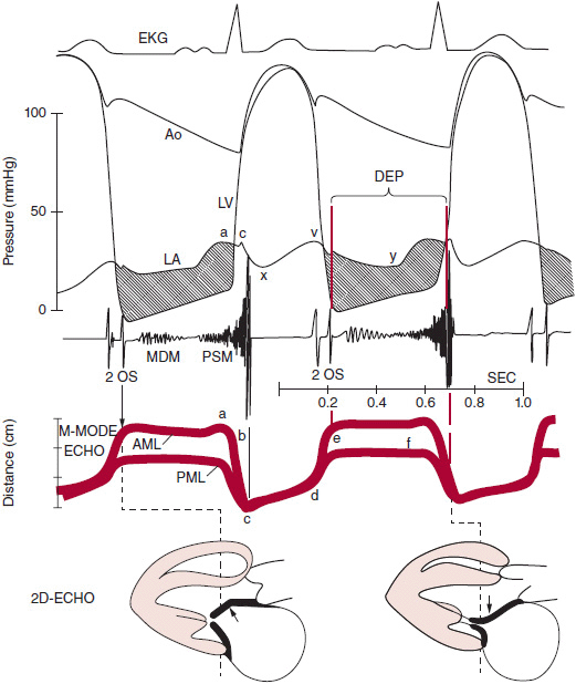 Wiggers Diagram Mitral Stenosis - vrogue.co