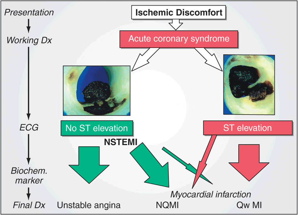 STSegment Elevation Myocardial Infarction… 415 Thoracic Key
