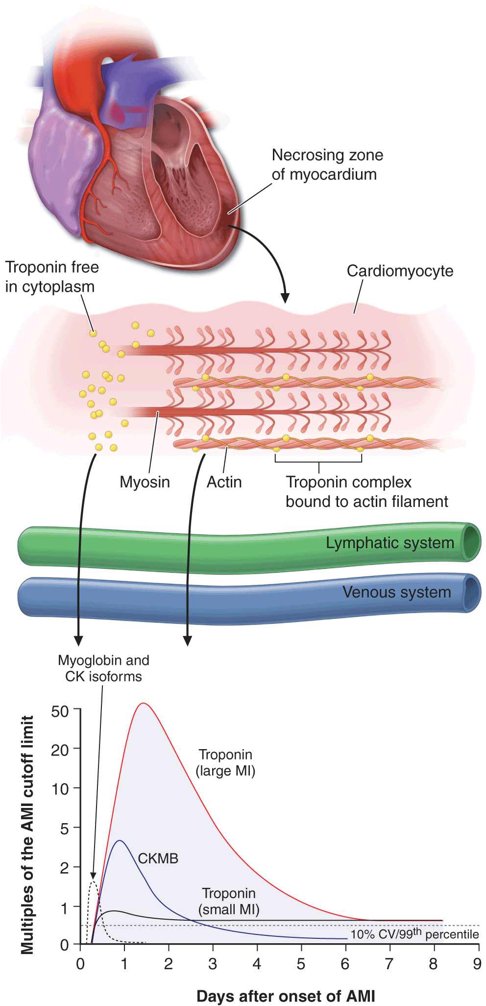 STSegment Elevation Myocardial Infarction… 415 Thoracic Key