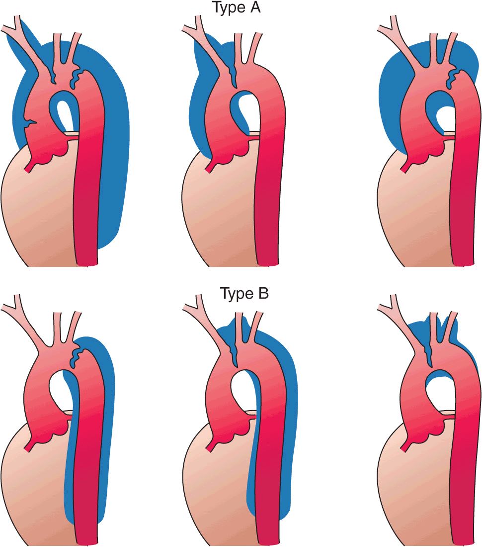 Diseases of the Aorta Thoracic Key
