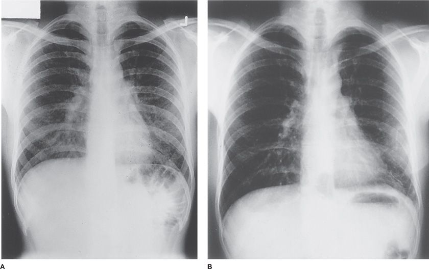 Hypersensitivity Pneumonitis Thoracic Key