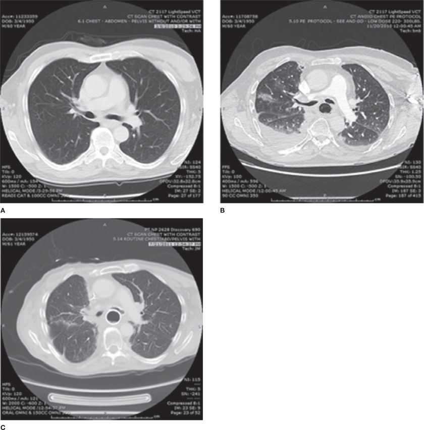 Radiation Pneumonitis Thoracic Key
