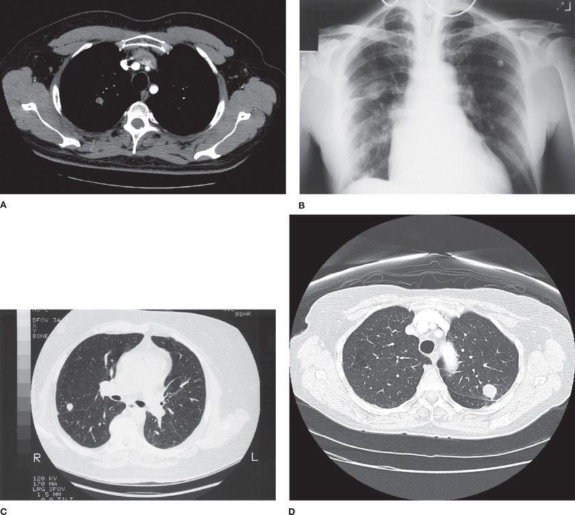 Approach to the Patient with Pulmonary Nodules Thoracic Key