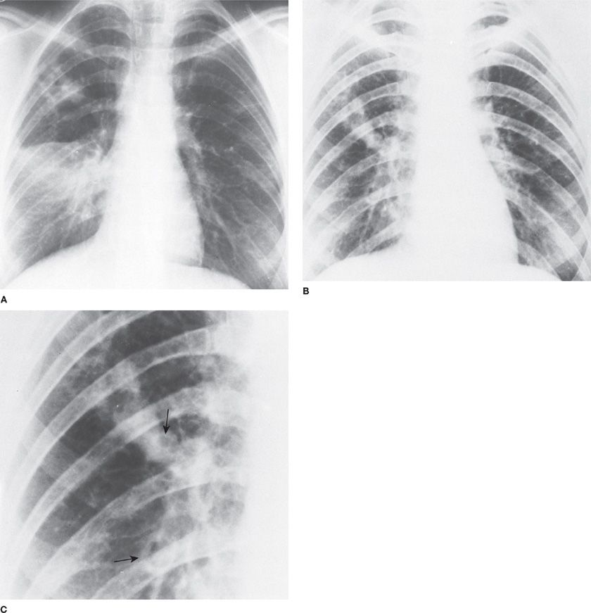 Aspergillus, Candida, and Other Opportunistic Mold Infections of the