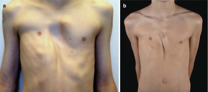 Nonsurgical Treatment for Pectus Excavatum and Carinatum Thoracic Key
