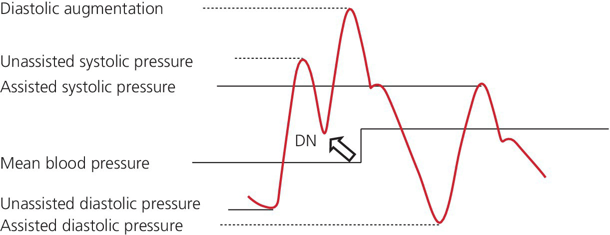 RA/CVP Waveform Interpretation RK.MD