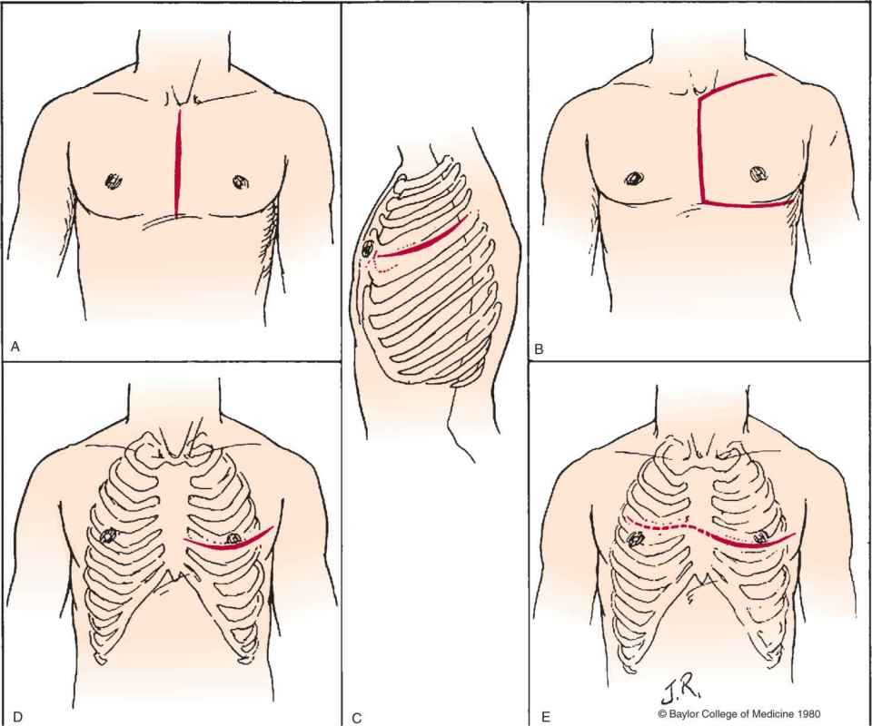 Trauma Thoracotomy Principles and Techniques Thoracic Key