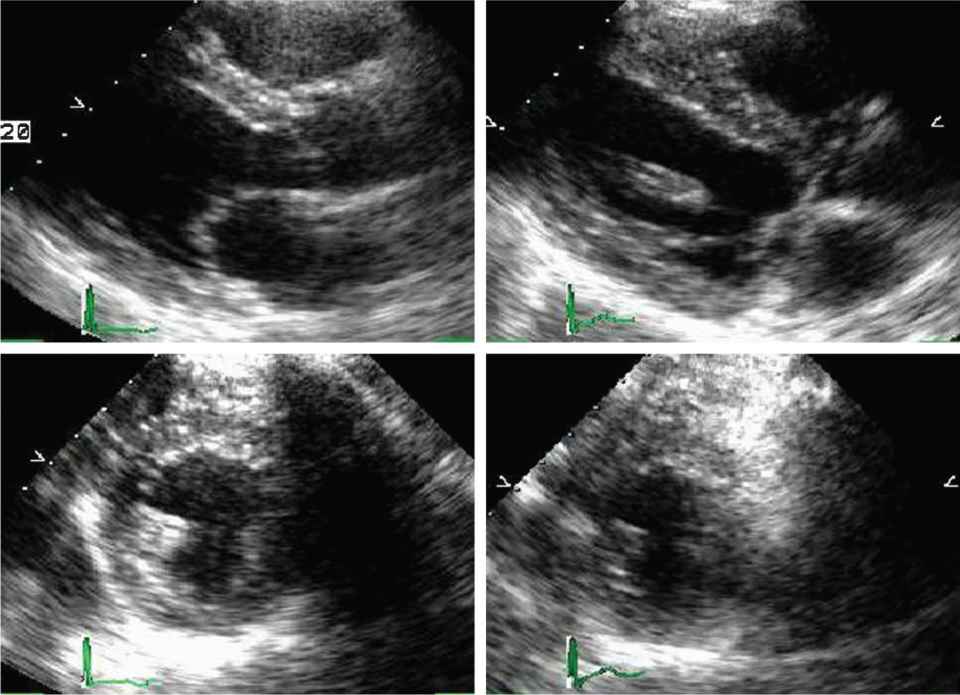 Echocardiography In The Evaluation And Management Of The Patient With Known Or Suspected Coronary Artery Disease Thoracic Key