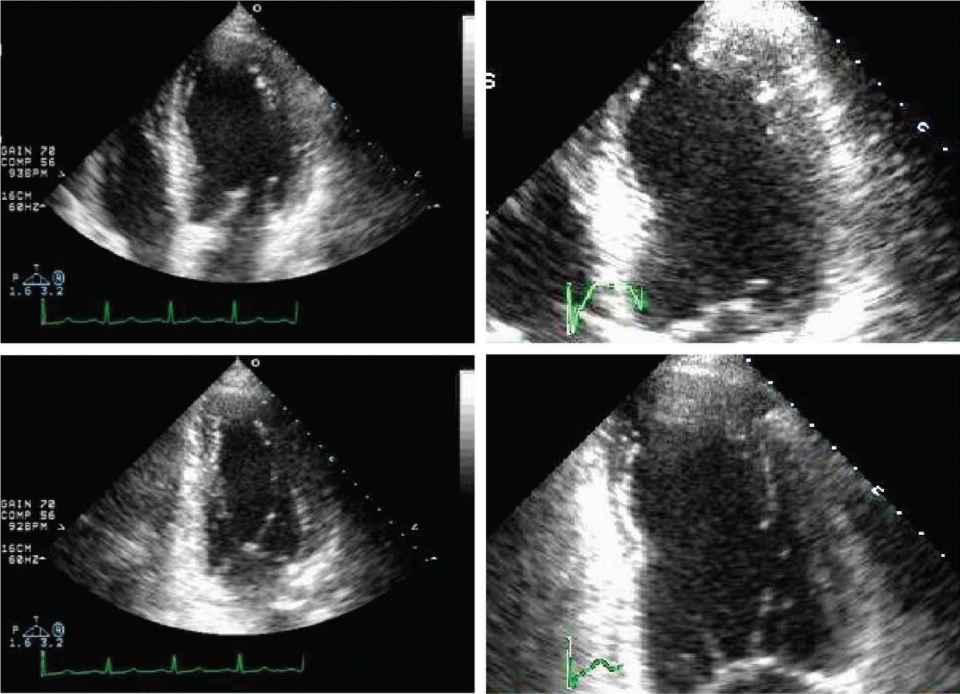 Echocardiography In The Evaluation And Management Of The Patient With Known Or Suspected Coronary Artery Disease Thoracic Key