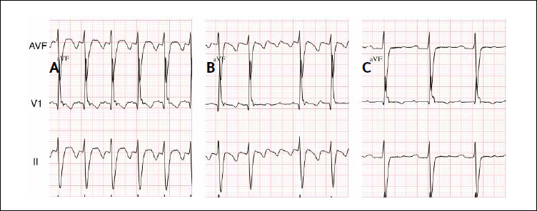 How to Ablate Typical and Reverse Atrial Flutter | Thoracic Key