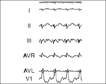 How to Ablate Typical and Reverse Atrial Flutter | Thoracic Key