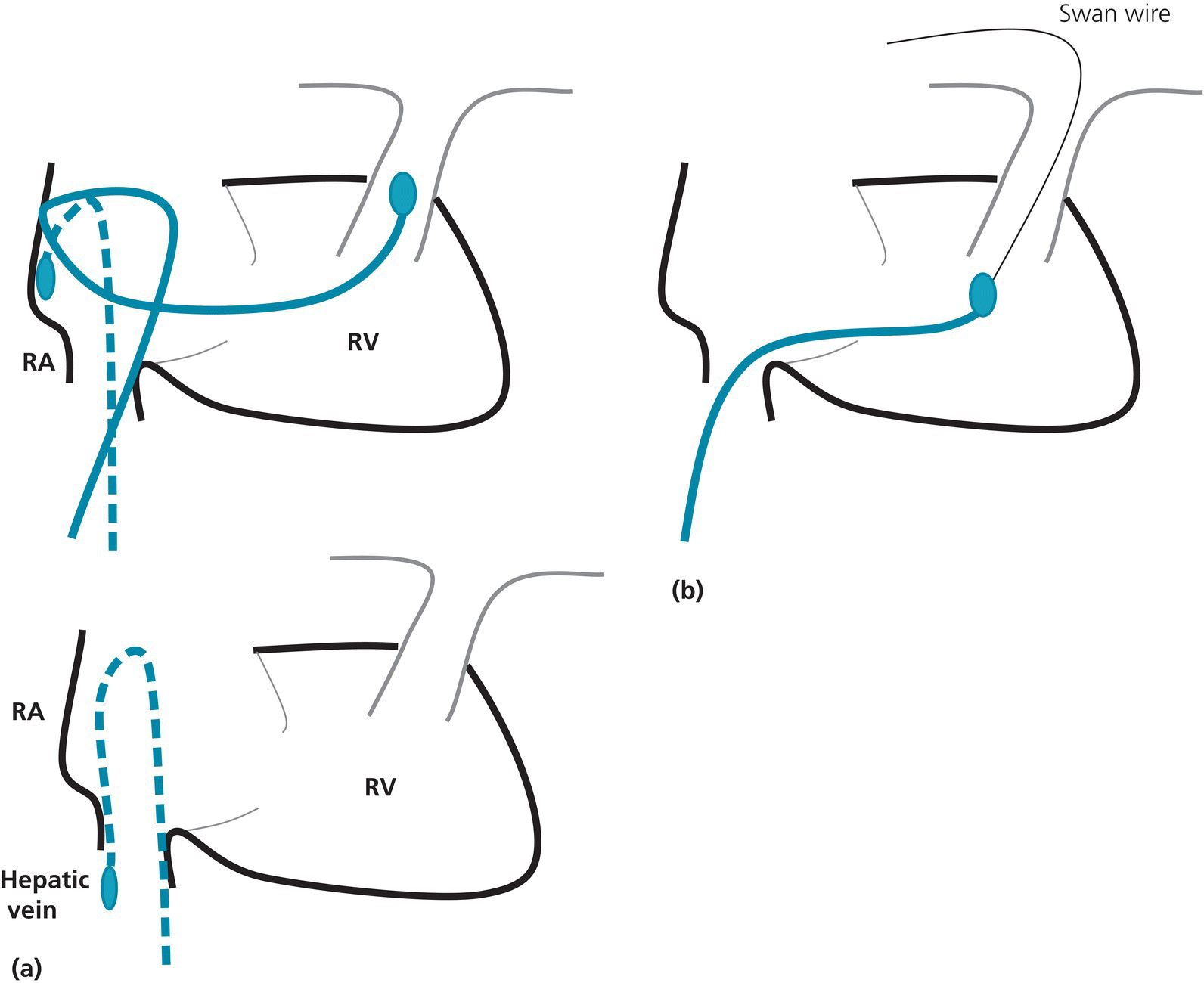 Cardiac Catheterization Techniques, Tips, and Tricks Thoracic Key