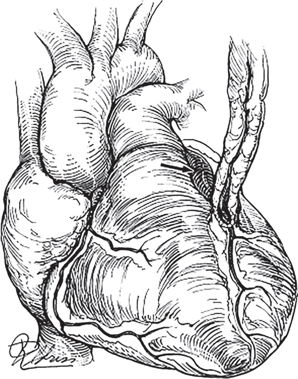 Coronary Artery Anomalies | Thoracic Key