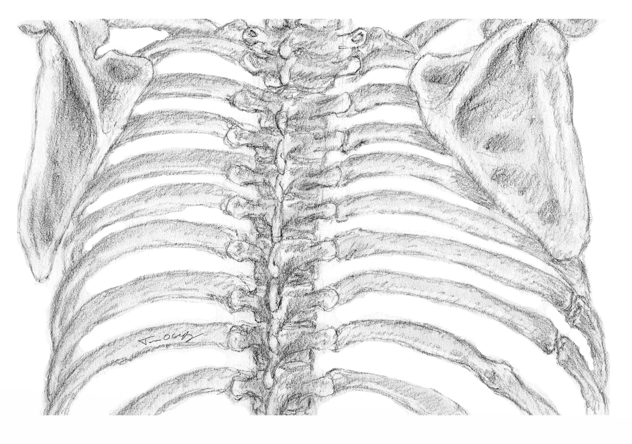 Fracture de côtes thoracotomie