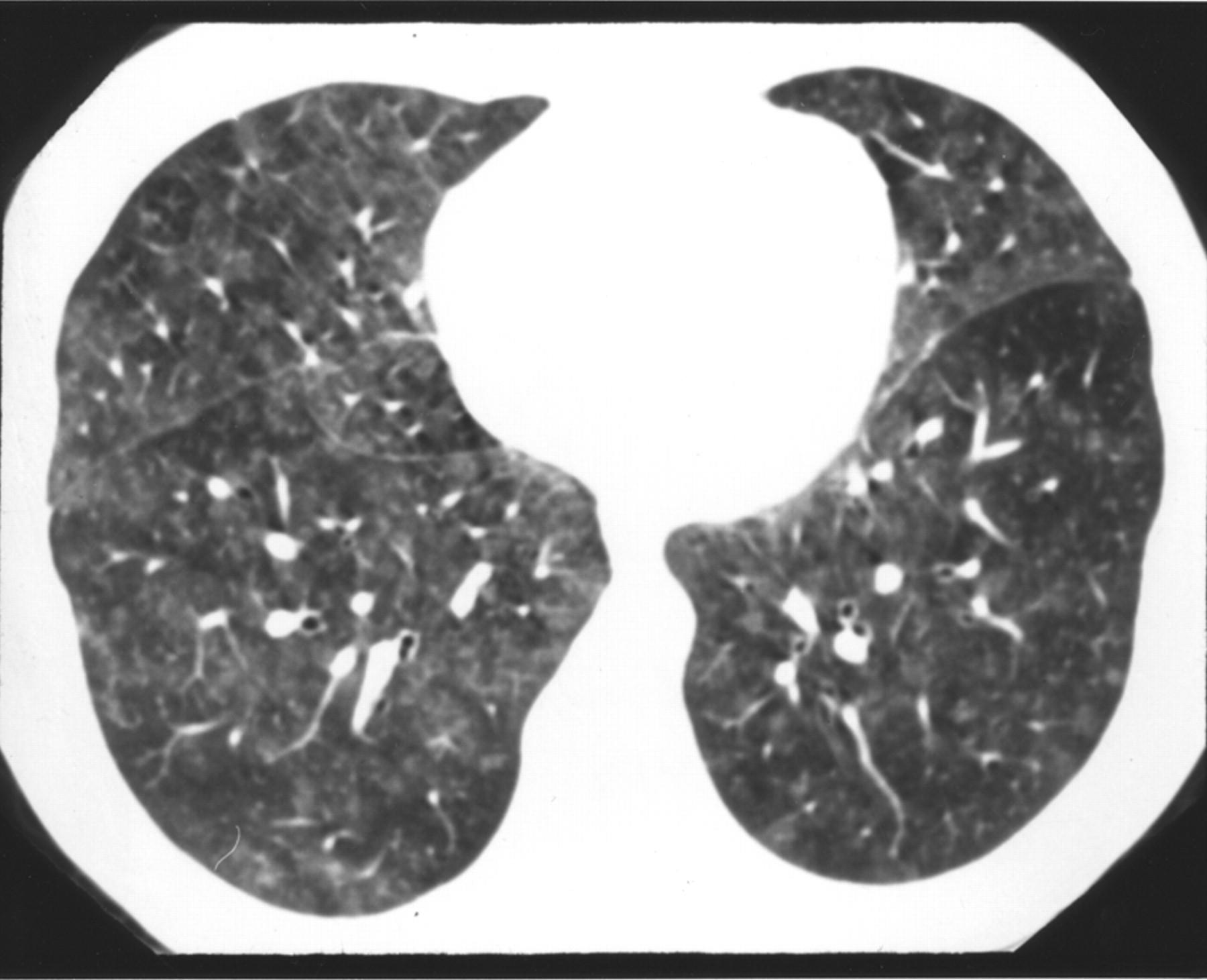 hypersensitivity pneumonitis meddic