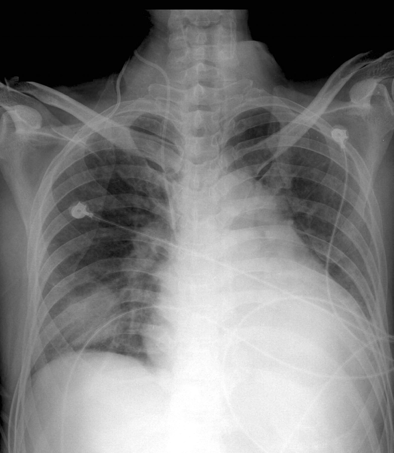 Pulmonary infarction from central venous air embolism mimicking round