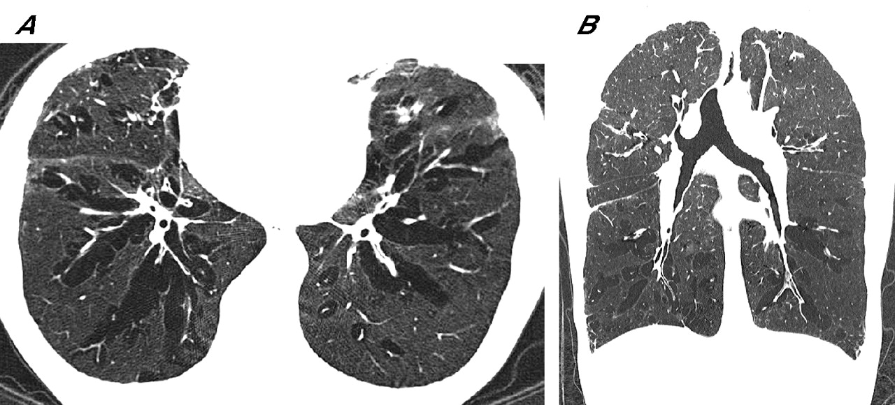 Persistent diffuse pulmonary interstitial emphysema mimicking pulmonary