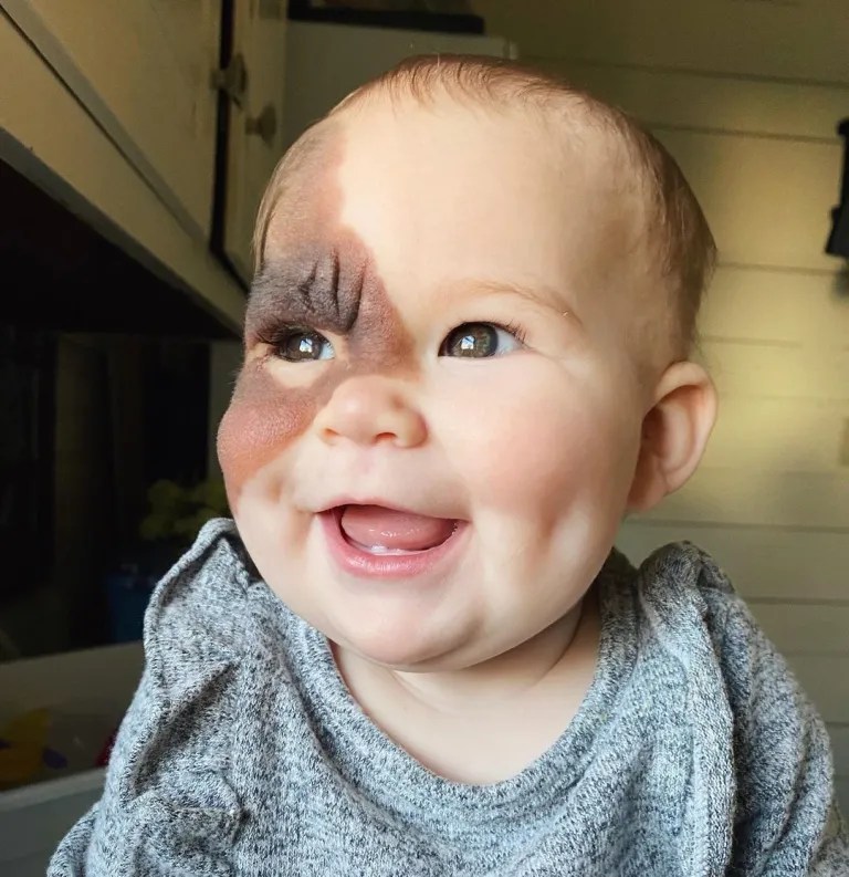 Mother Of Baby With Rare Birthmark Shows How Beautiful Her Daughter Is