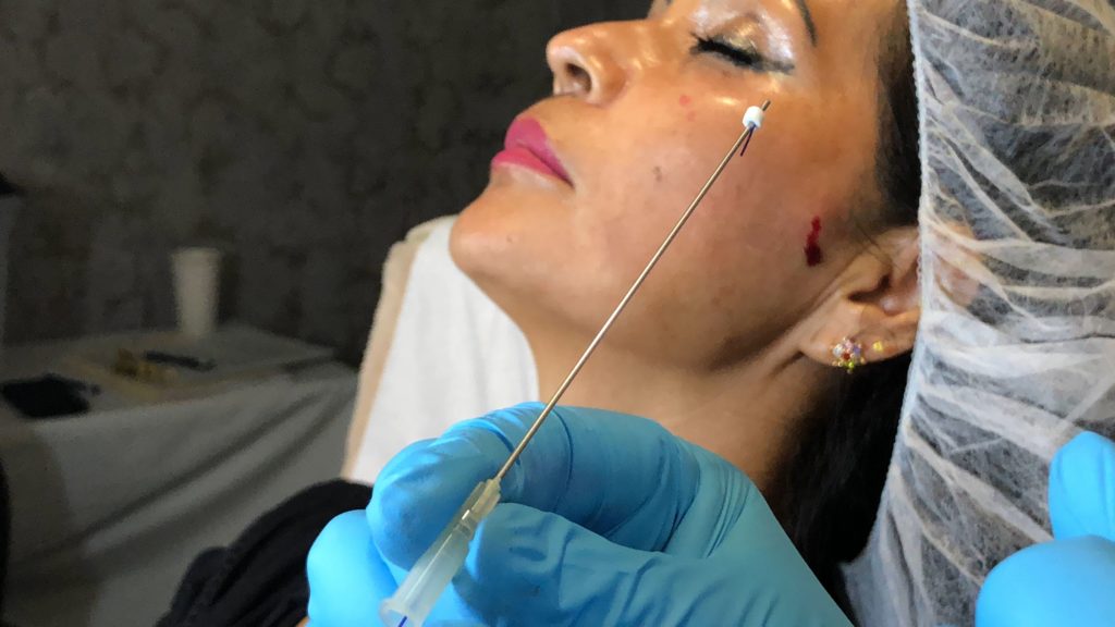 PDO Thread Lifts Thread Lift Training Course