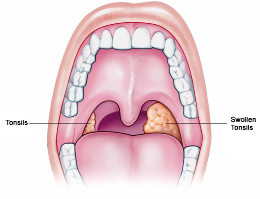 How Much Does It Cost To Get Your Tonsils Removed aimswt