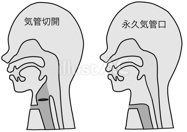 Free Vectors Difference between tracheostomy and permanent tracheostomy