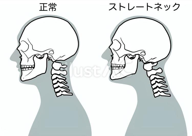 正常な頚椎とストレートネックイラスト No 23688324｜無料イラスト・フリー素材なら「イラストAC」