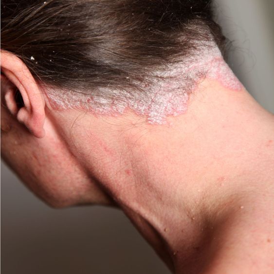 Severe Psoriasis - Neck" By Farina3000 - Mostphotos