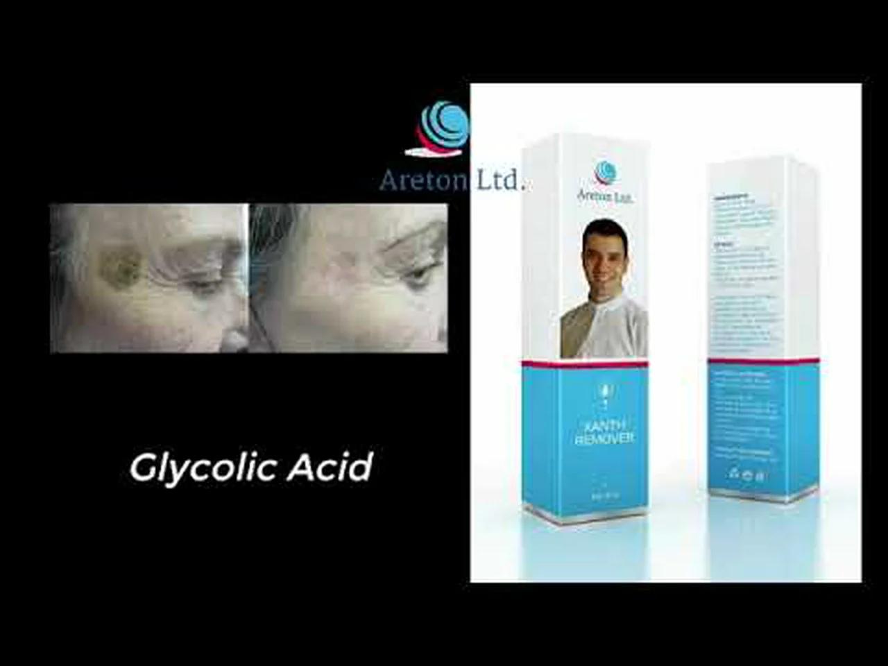 Seborrheic keratosis Removal using XanthRemover 70 Glycolic Acid Peel at home