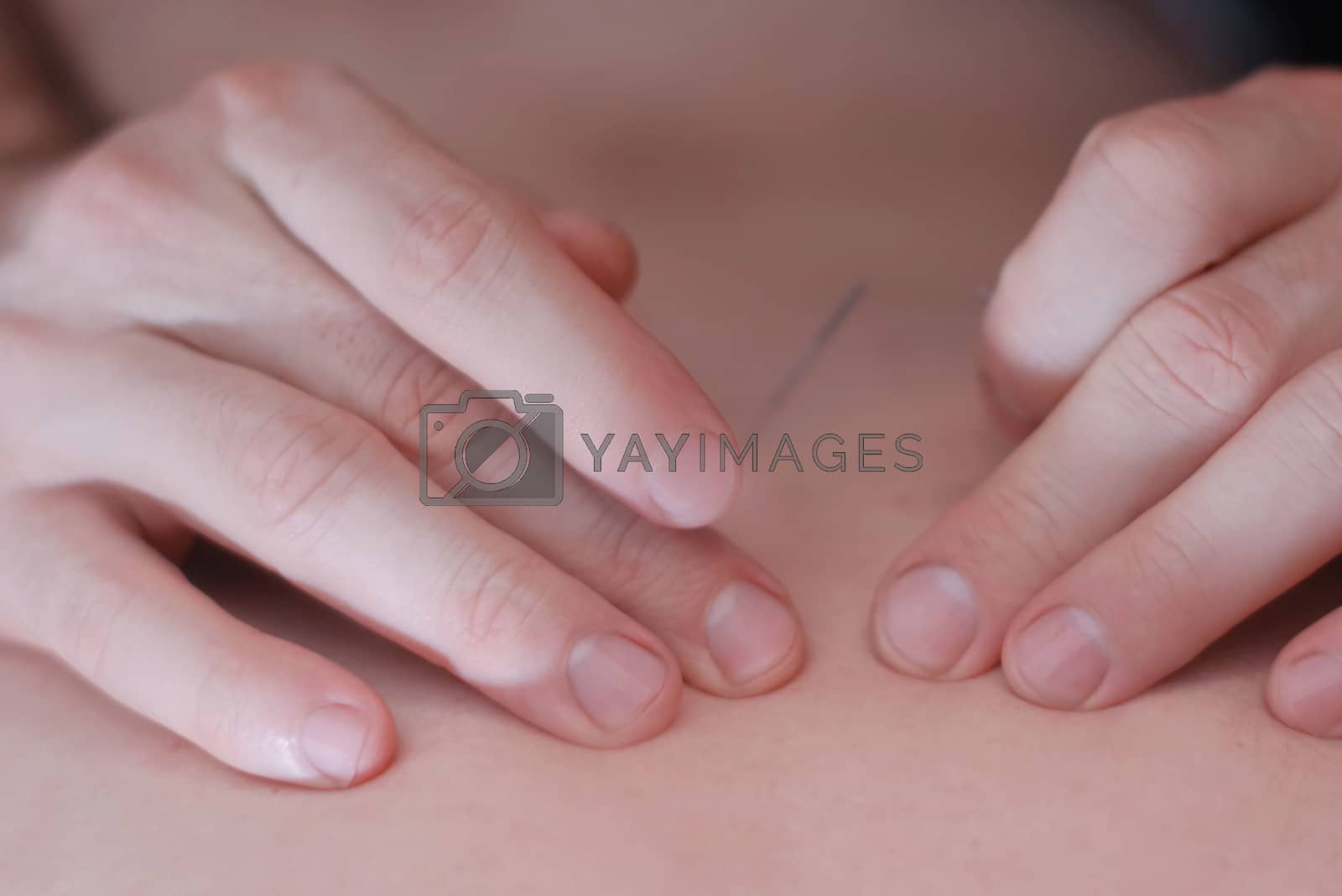Royalty Free Image Acupuncture, is used to relieve pain