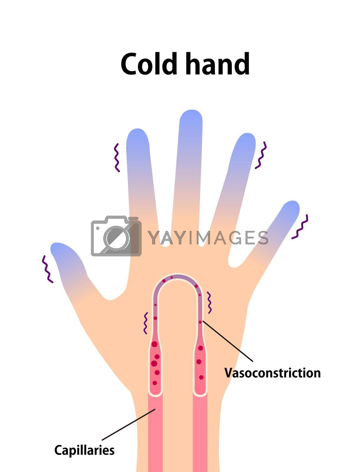 Royalty Free Vector Cold hand blood circulation illustration