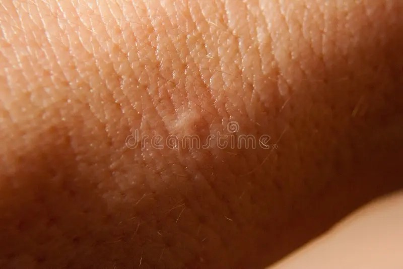Bed bug bite stock photo. Image of lesions, dermis, skin 15374448