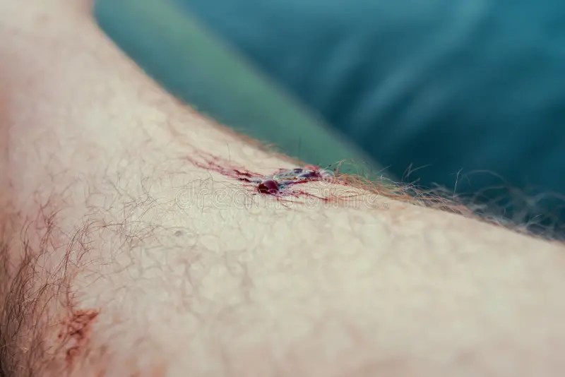 Animal bite wound leg stock image. Image of heal, body 33498323