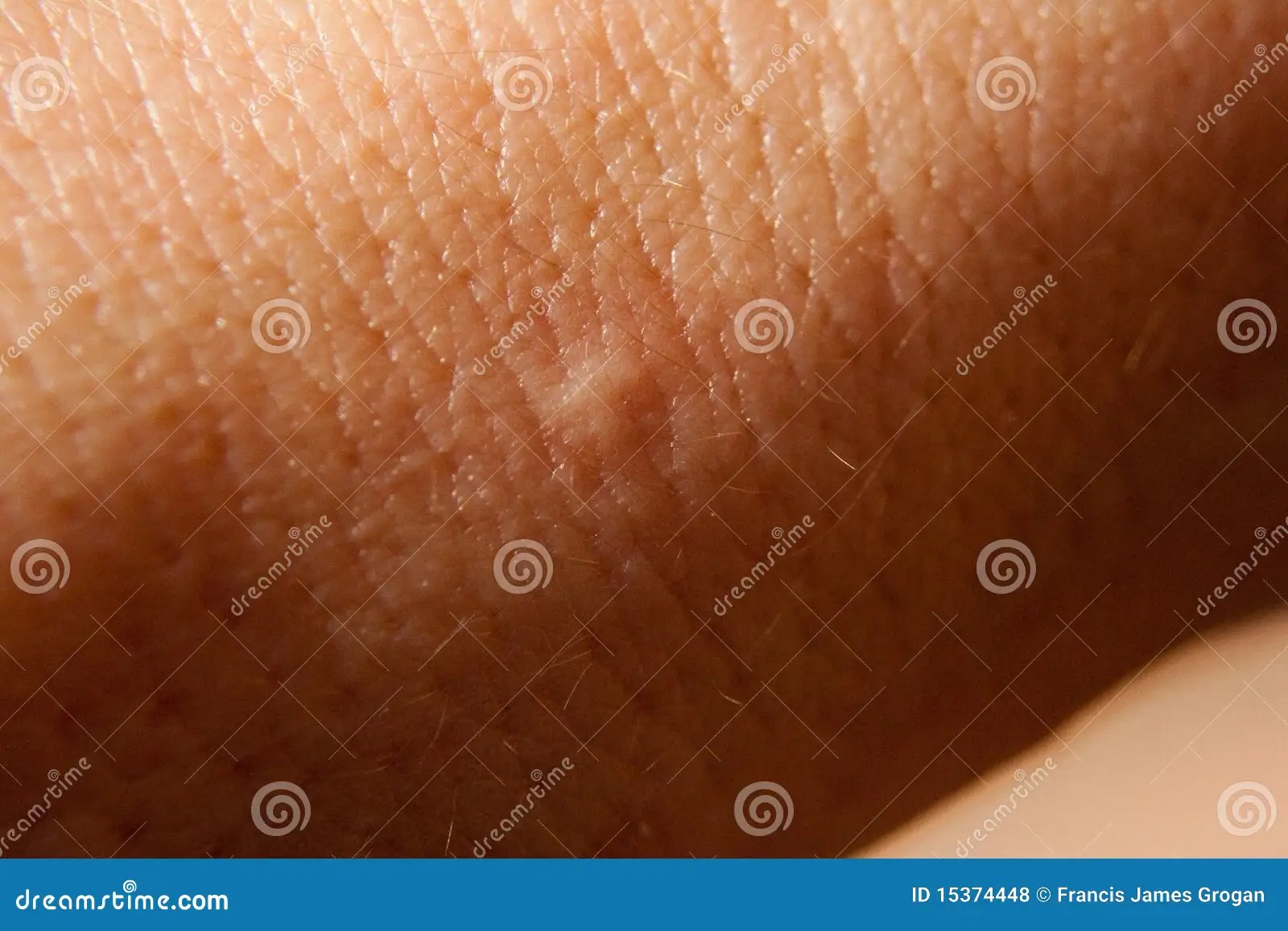 Bed Bug Bite Royalty Free Stock Photos Image 15374448