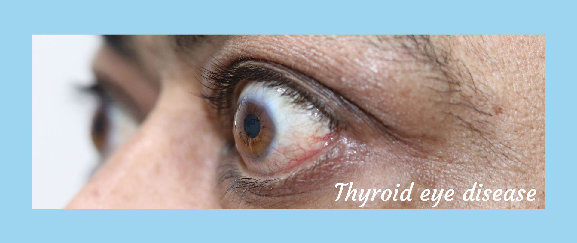 Homepage Thyroid Eye Disease