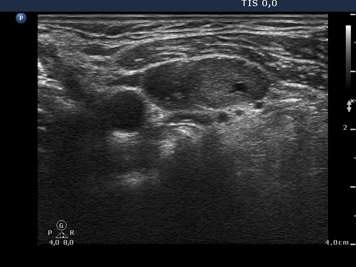 Lymph nodes in the neck