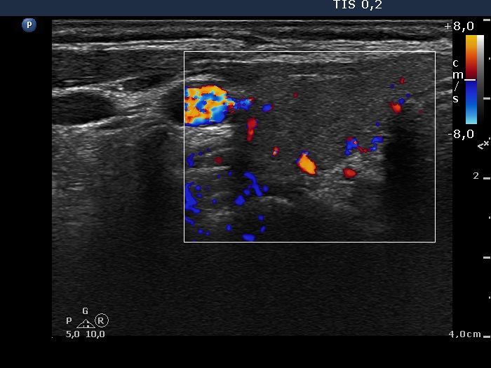 Subacute thyroiditis