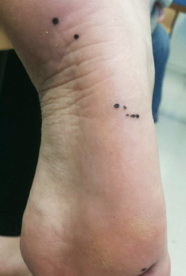 Black Macules On The Sole Of The Foot | Tidsskrift For Den Norske Legeforening