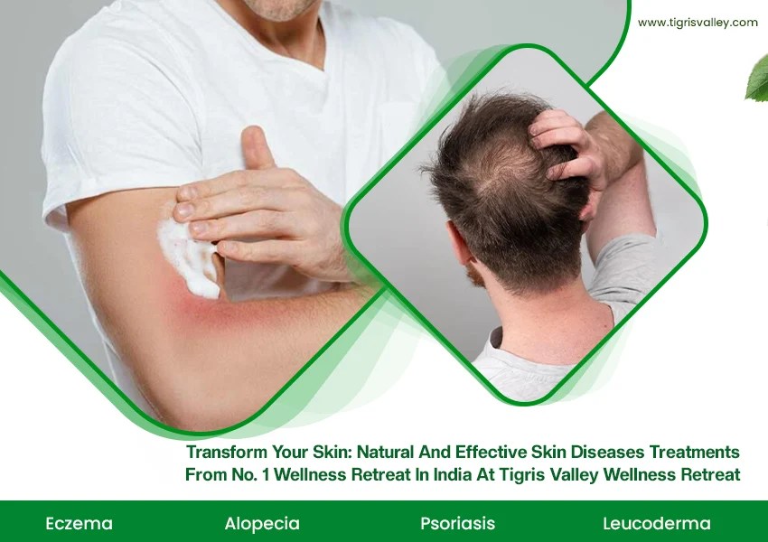 Advanced Skin Care Treatments in Kerala Eczema Psoriasis