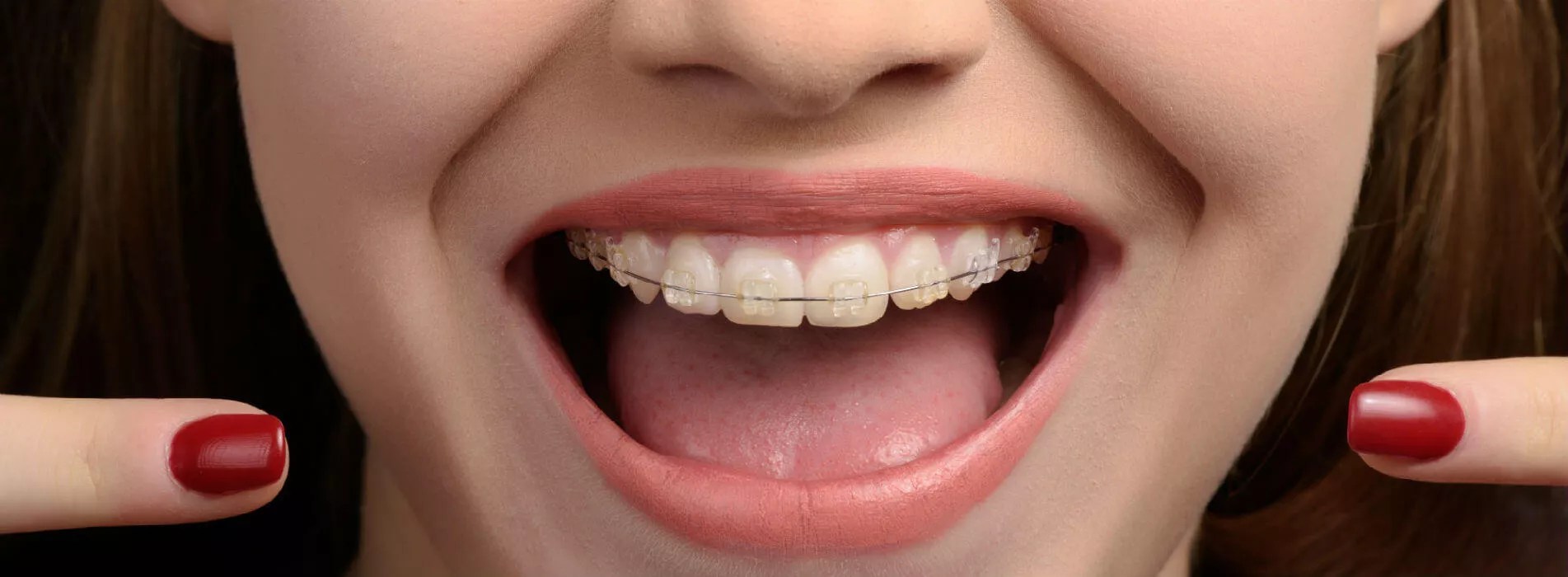 Brackets Aparatos dentales Ortodoncia en Madrid