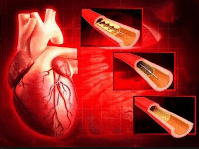 Coronary stents set to get cheaper Times of India