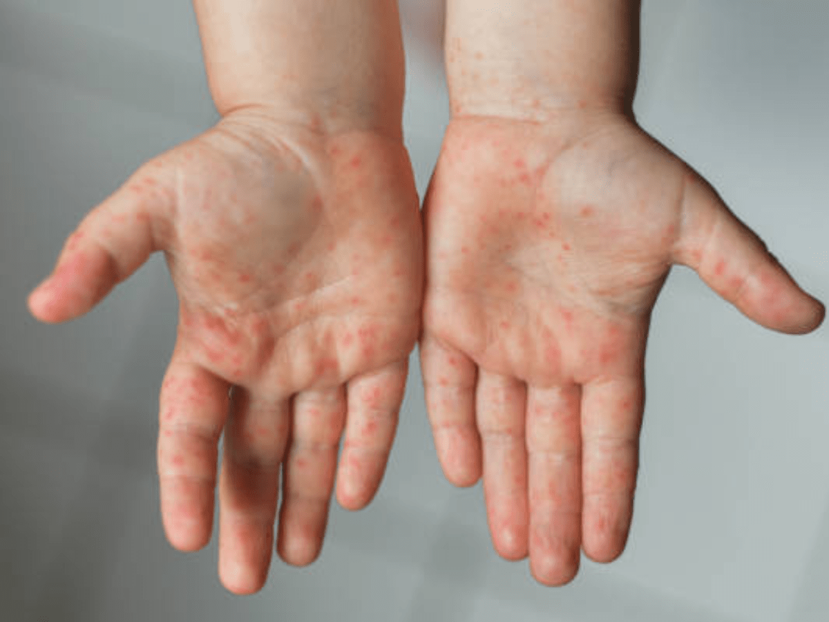 Tomato fever Symptoms that confuse parents News 24 Classic Times