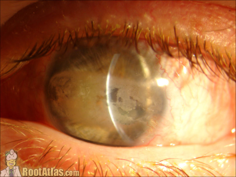 Band Keratopathy EDTA chelation (Video)