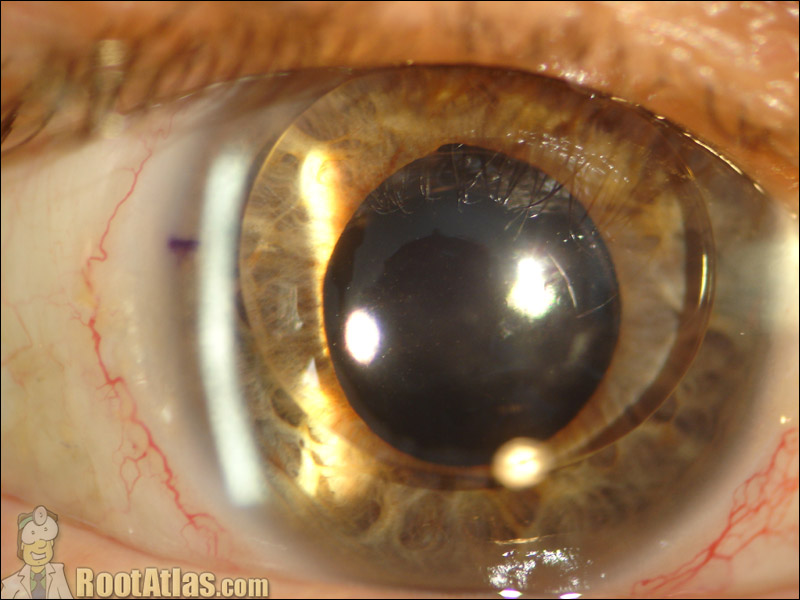 Silicone oil complication (Photo)