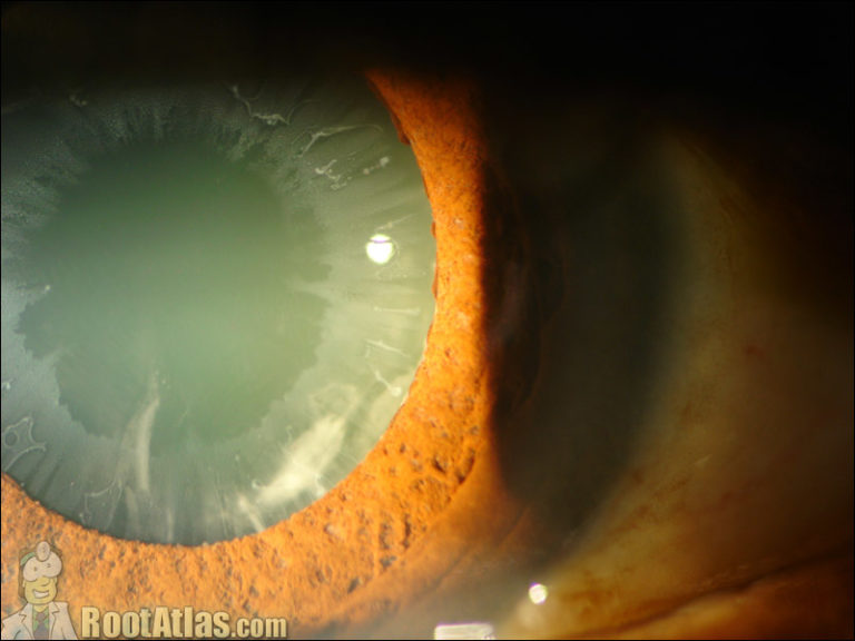 Severe Pseudoexfoliation Syndrome (Video)