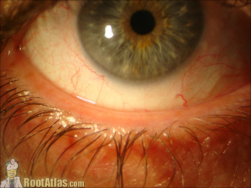 Glaucoma Drop Side Effects (Video) - Timroot.com
