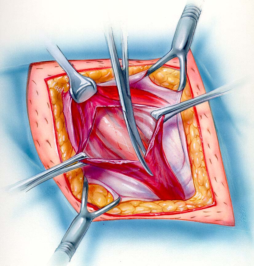 TRABUCCO HERNIA INSTITUTE