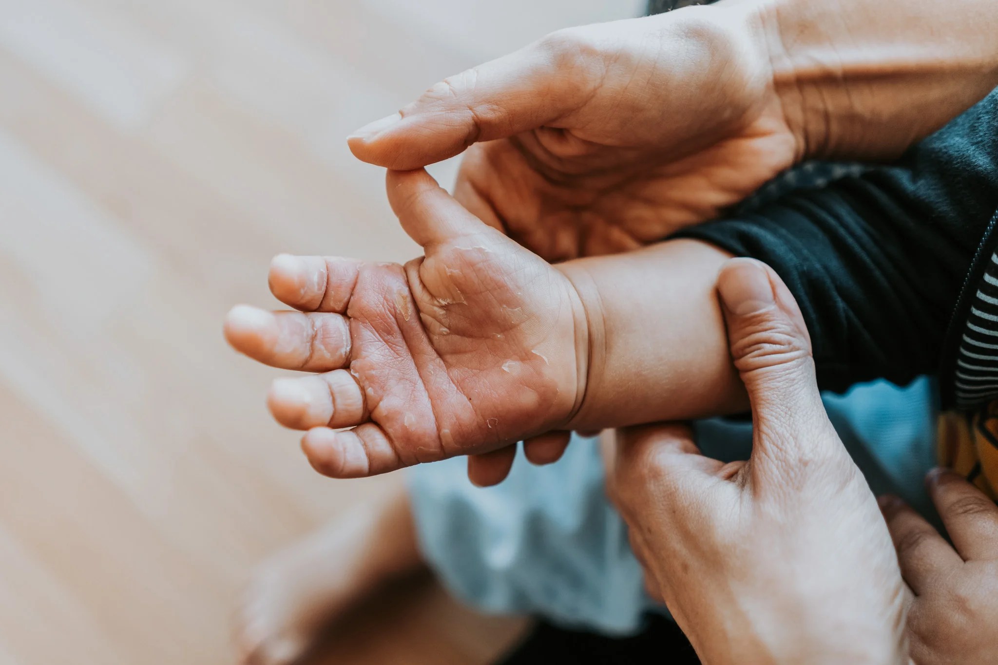 Burns prevention and first aid