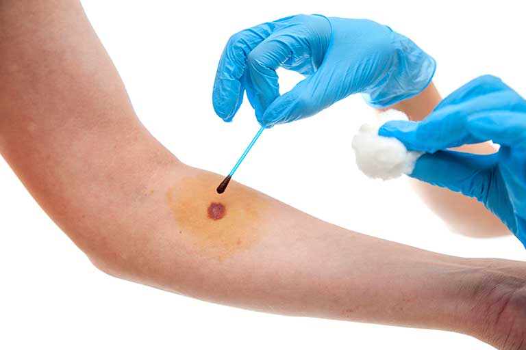 Top 10 Best Home Remedies and Guide For Staph Infection